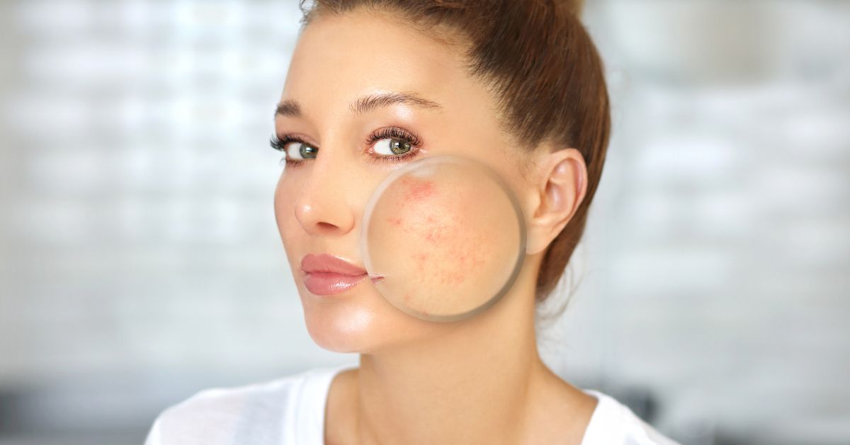 Can Tanning Salon Help Acne at Phillip Davis blog